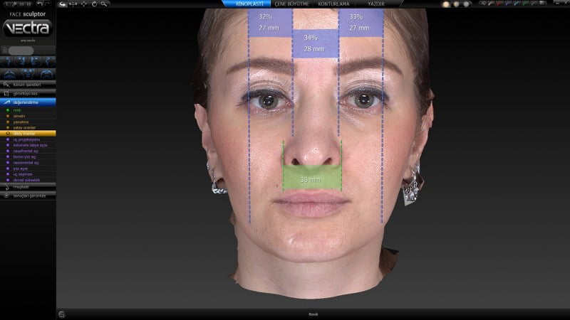 3D Vectra ile yüz-burun oran analizi