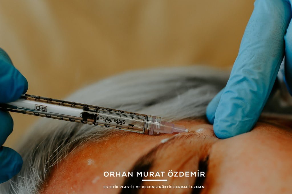 kaz ayağı botoksu ankara