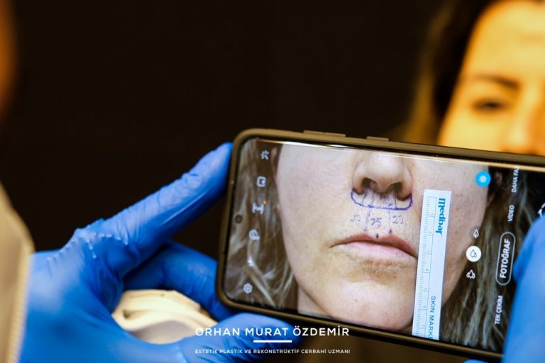 Lip Lift (Dudak Kaldırma) Ameliyatı Ankara
