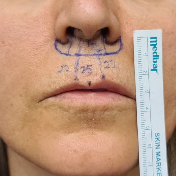 lip lift fiyat ücret ne kadar