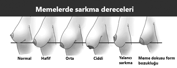 meme de sarkma dereceleri mastopeksi göğüs dikleştirme