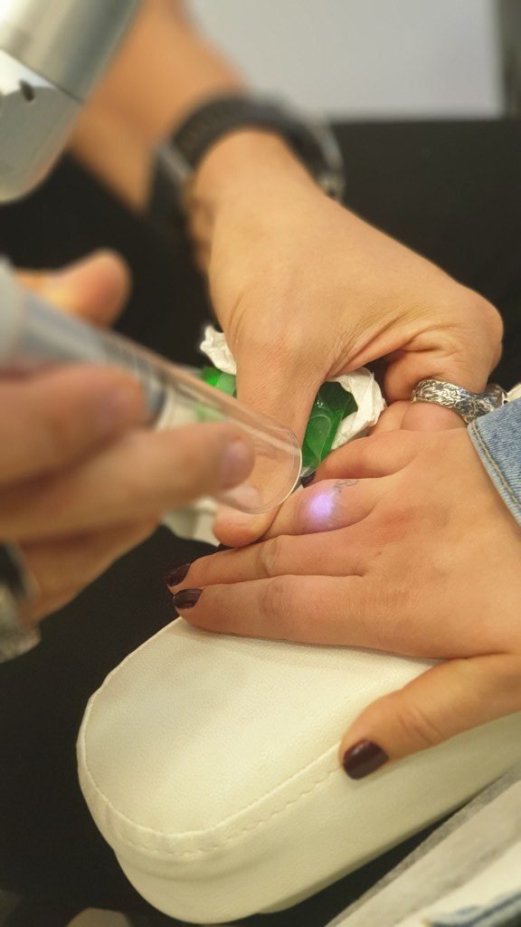 lazerle dövme sildirme fiyatları ankara