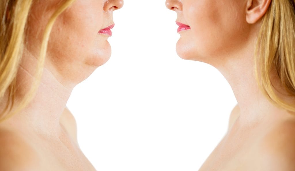 gıdı liposuction ankara