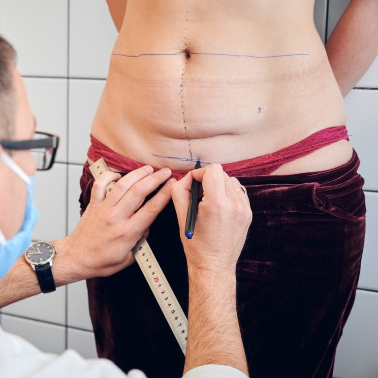 Karın germe (Abdominoplasti)