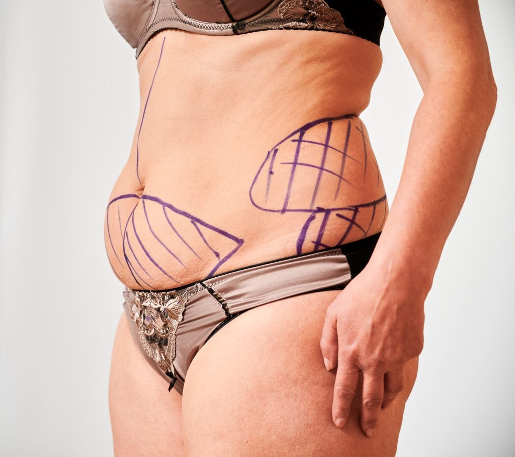 karın liposuction ankara