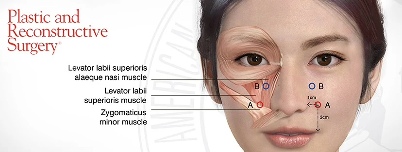 Yonsei noktası — Gummy smile tedavisinde botoks enjeksiyon noktası anatomisi
