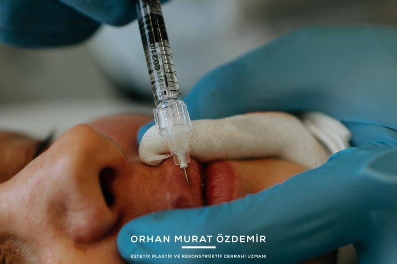 Dudak Dolgunlaştırma Yöntemleri