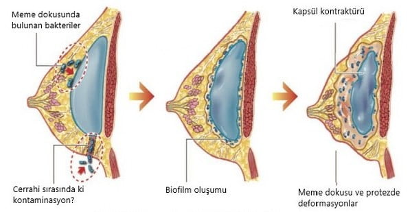 kapsül kontraktürü nasıl oluşur