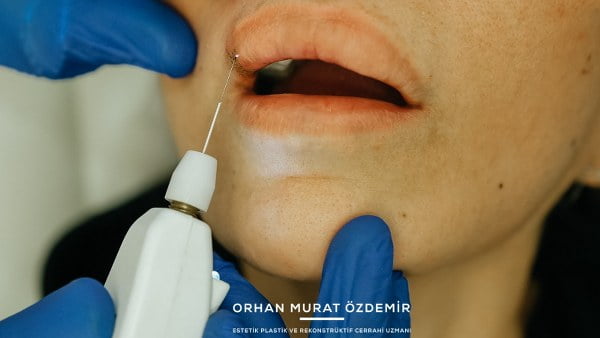 dudak plexr uygulaması