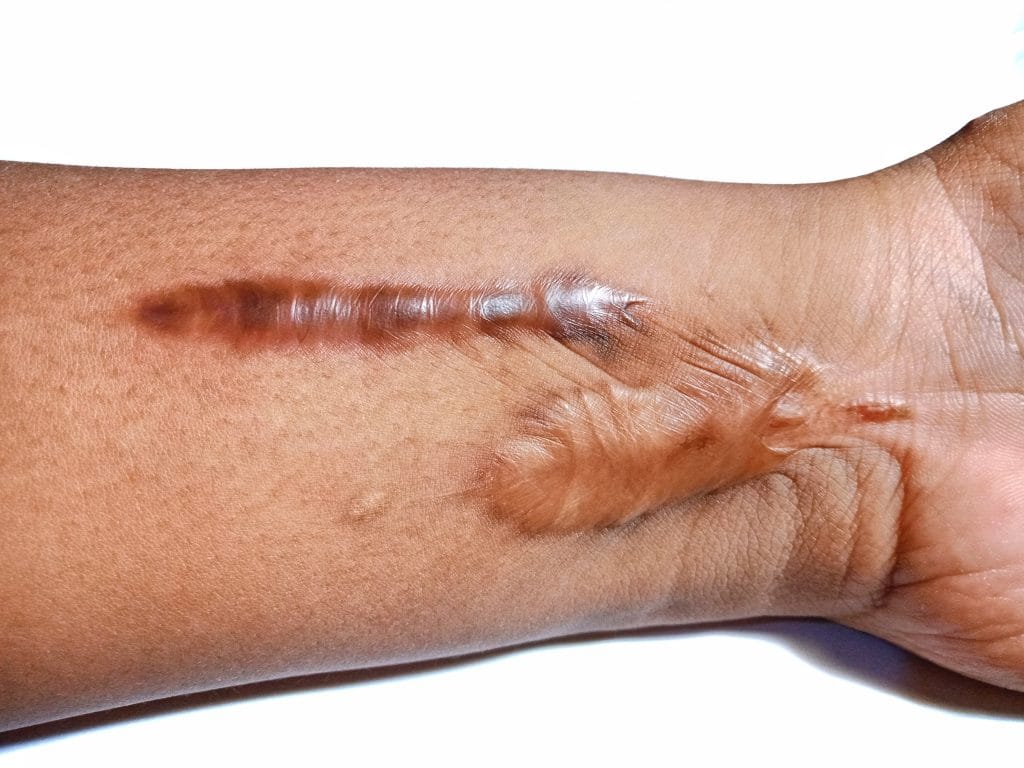 Keloid, hipertrofik skar, ameliyat izi, yanık izi