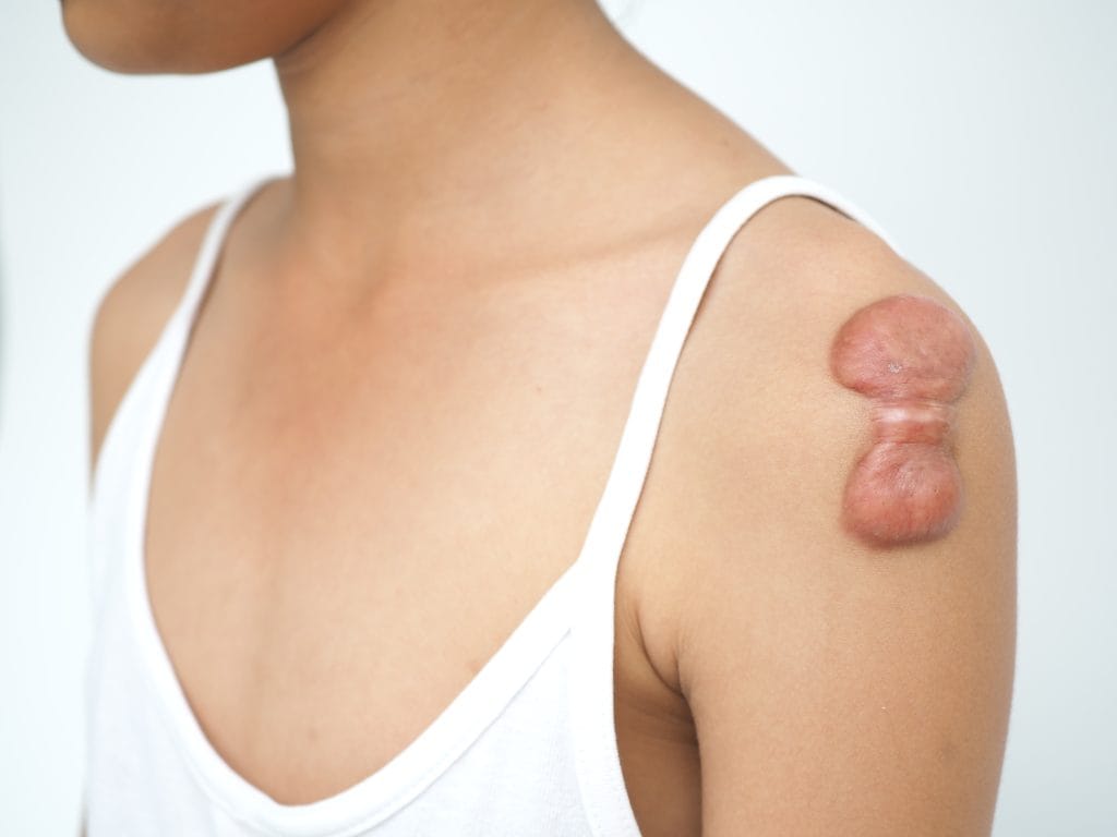 Keloid, aşı izi, hipertrofik skar, iz