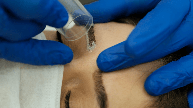 Kaş Silme [Microblading] Lazer - Ankara