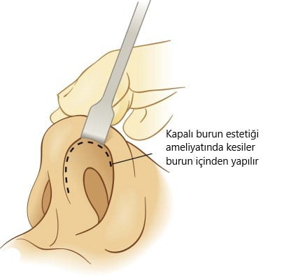kapalı burun ameliyatı