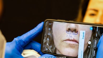 Lip Lift (Dudak kaldırma) ameliyatı 20 lip lift dudak kısaltma ameliyatı