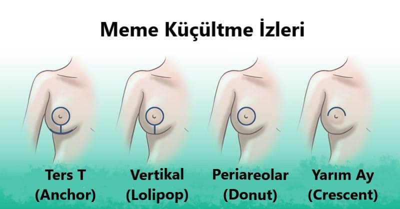 Meme Küçültme Ankara 4 ankara meme küçültme izleri