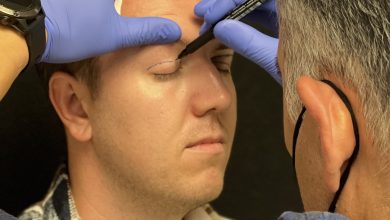 Göz kapağı estetiği 18 göz kapağı estetiği ankara