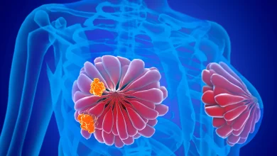 fibroadenom meme büyütme ankara önemli bir sorun mudur