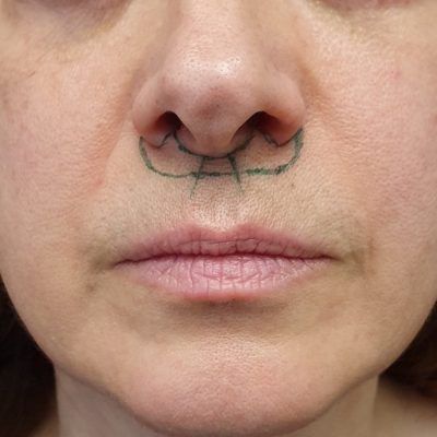 lip lift dudak kaldırma bullhorn ameliyatı planlaması